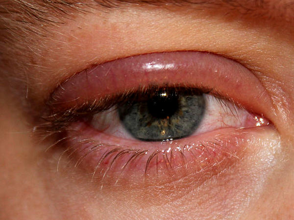 inflamatie ochi pleoapa sincron cu vederea slabă